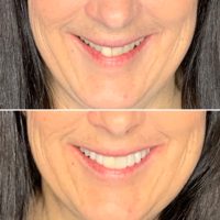 Image of Cosmetic work at Nanton Dental