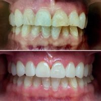 Smile Rejuvenation treatment at Nanton Dental