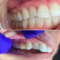 Pinhole technique used at Nanton Dental