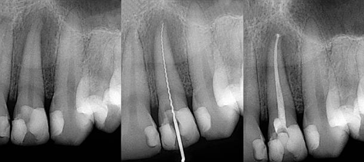 Image of Root Canal Therapy at Nanton Dental