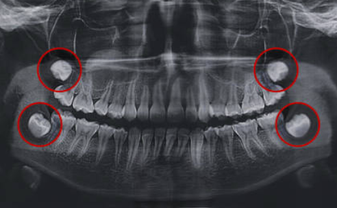 Image of an xray showing wisdom teeth Image of an xray showing wisdom teeth
