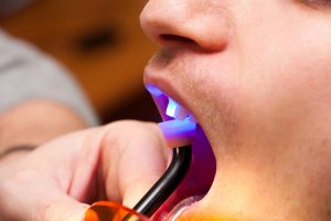 Image of dental bonding