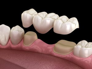 Dental bridge of 3 teeth
