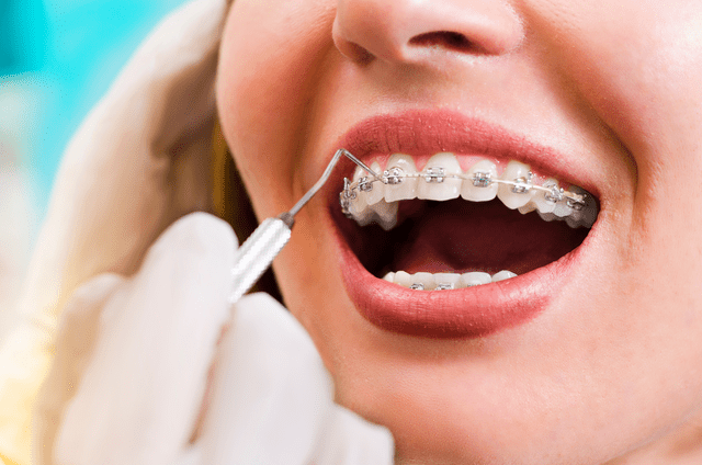 Traditional Braces