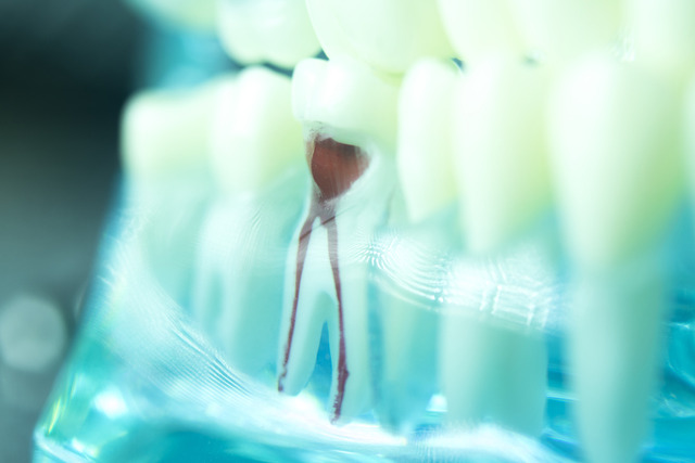 Root Canal Treatment