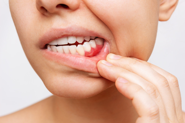 Gum Disease at nanton dental
