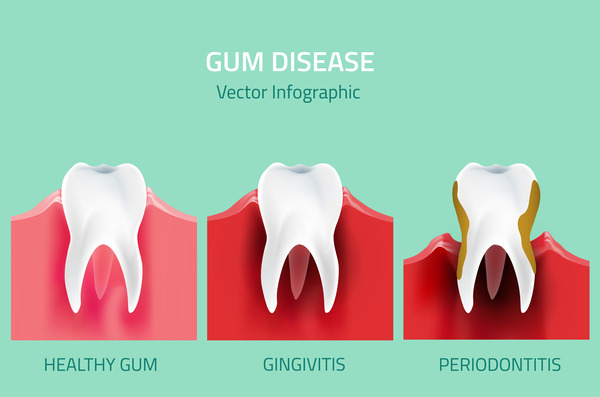 Gum Disease Treatment