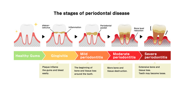 Stage of periodontal disease