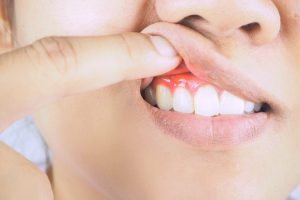 Woman with gum disease