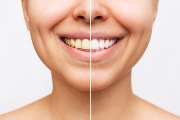 Before and After a dental cleaning