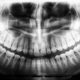 How to Plan for Recovery After Wisdom Teeth Removal